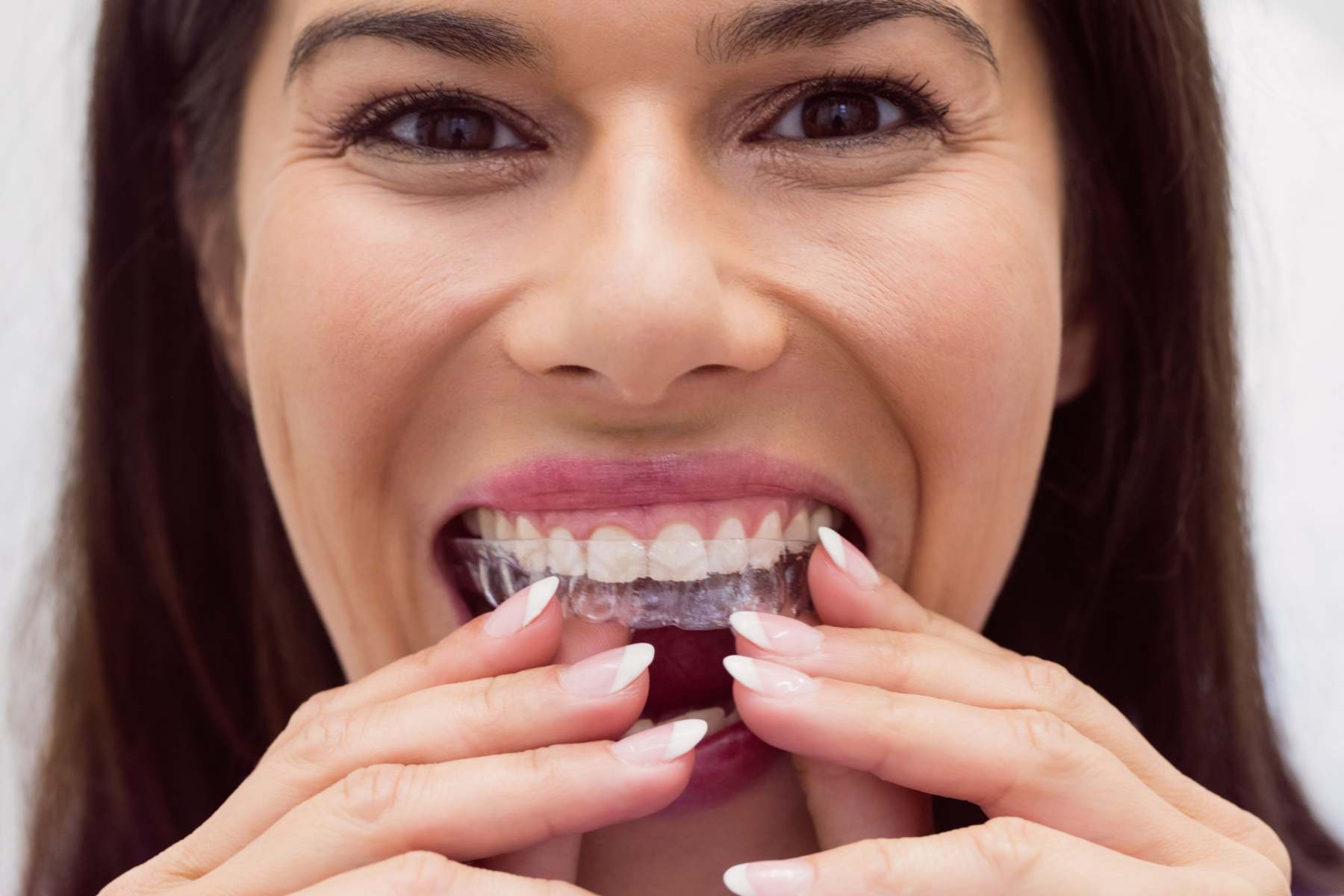 How much does invisalign cost?