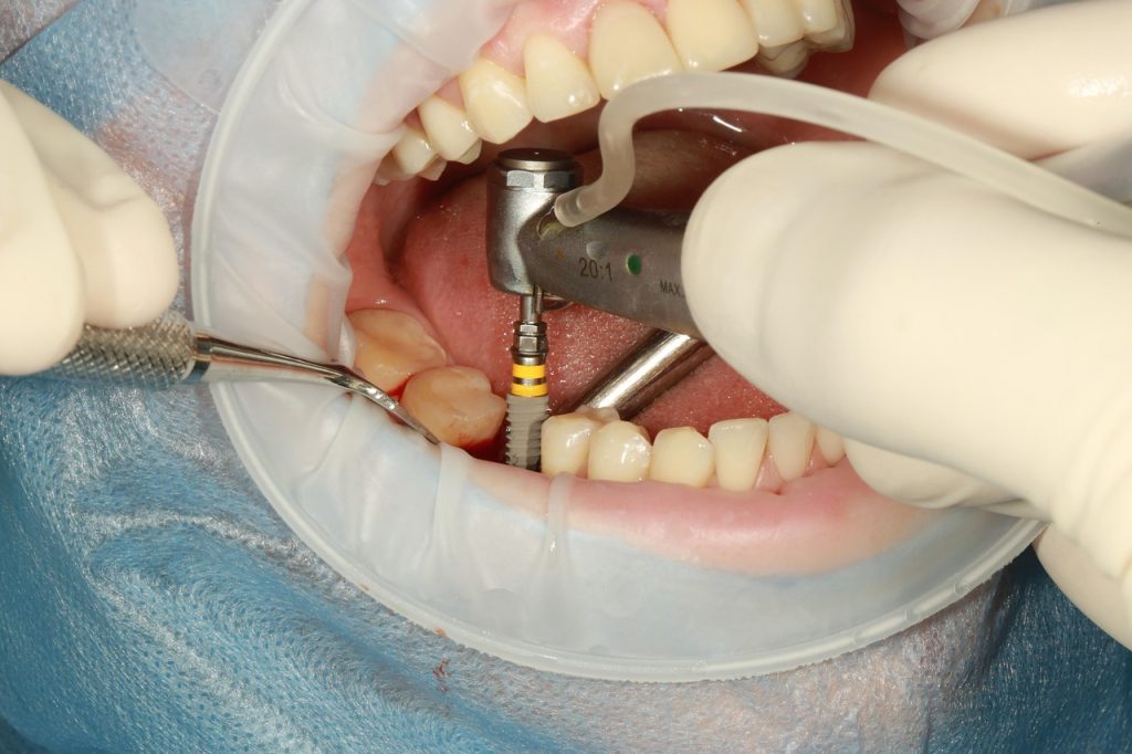 Why Choose Dental Implants?