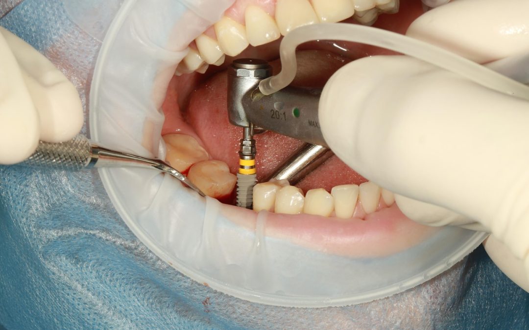 Why Choose Dental Implants?