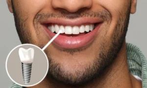 Dental Implants Cost in Canterbury